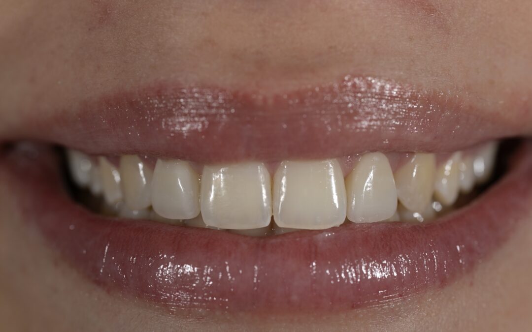 ESTETICA DENTALE. Faccette dentali in ceramica integrale