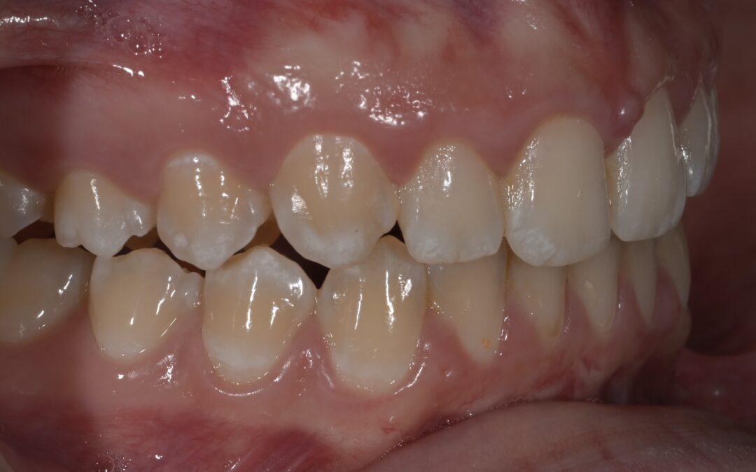 SBIANCAMENTO DENTALE. Sbiancamento domiciliare per fluorosi dentale