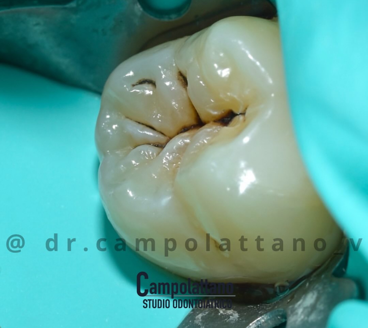 Lesione cariosa a carico di un molare